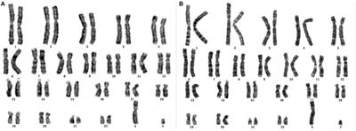 Case Report: Genetic Analysis of a Small Supernumerary Marker Chromosome in a Unique Case of Mosaic Turner Syndrome